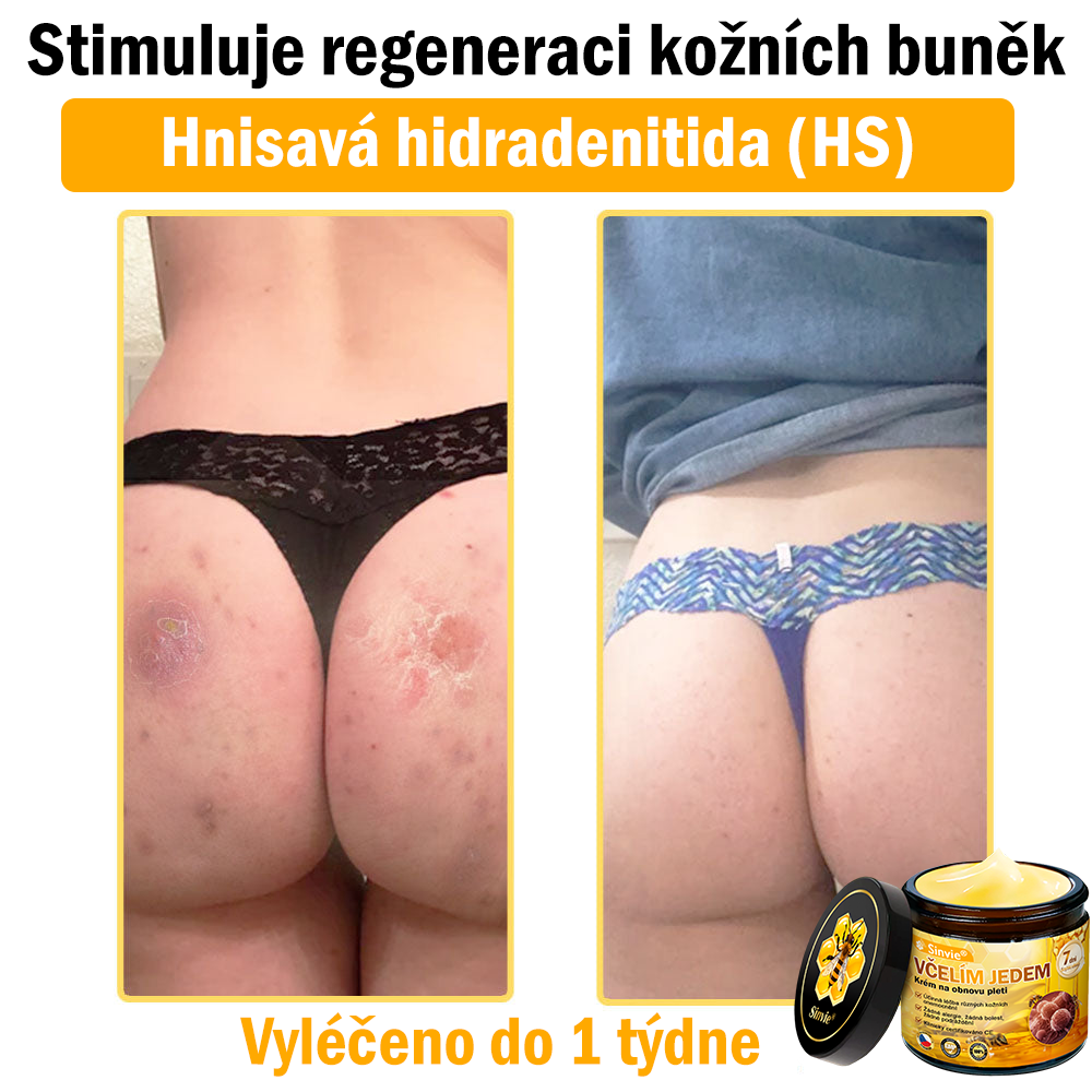 🔥🐝 Sinvie® Krém na obnovu pleti s včelím jedem(👨‍⚕‍CE schváleno)👍✅