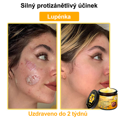 🔥🐝 Sinvie® Krém na obnovu pleti s včelím jedem(👨‍⚕‍CE schváleno)👍✅