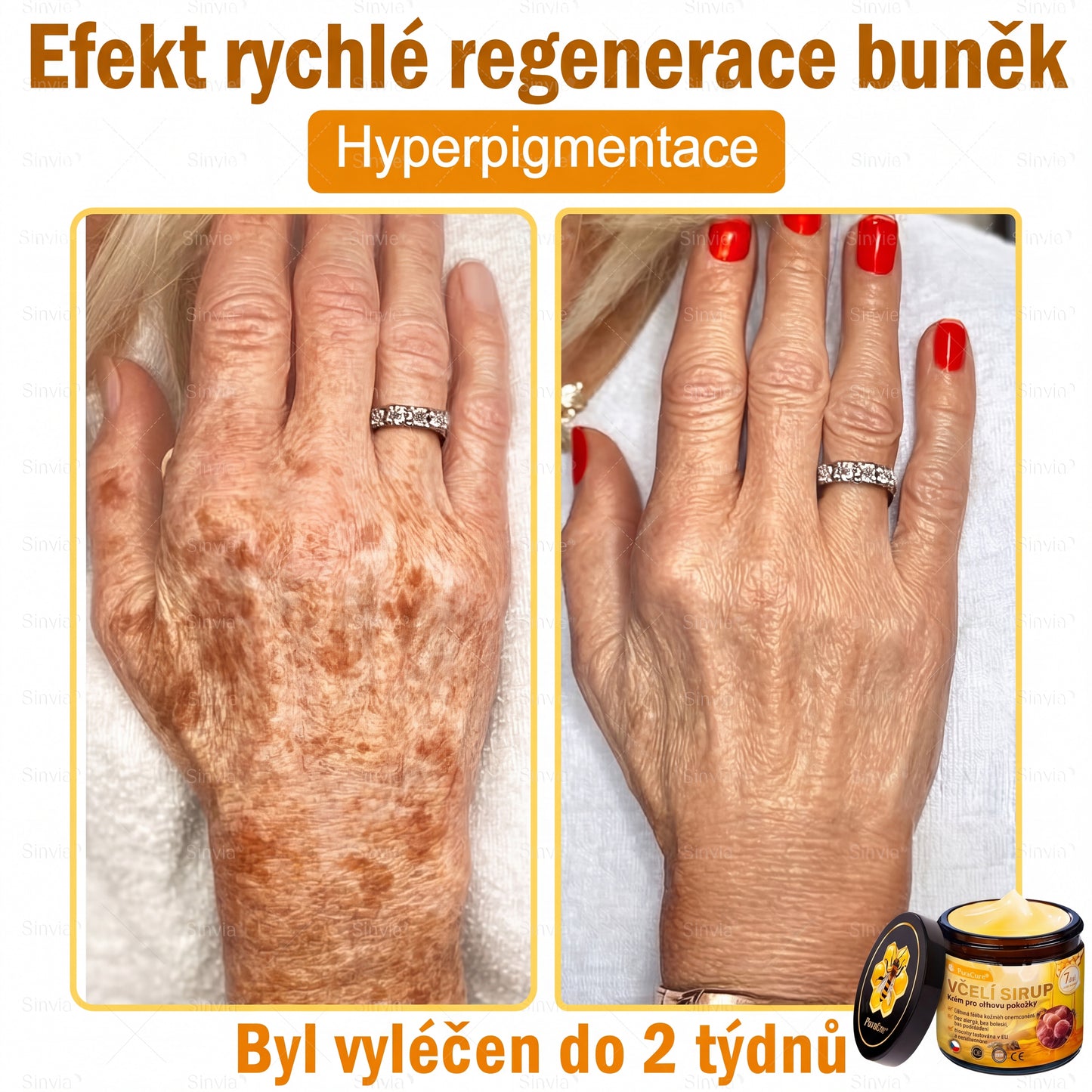 🩺🐝 PuraCure® Krém na obnovu pleti s včelím jedem(👨‍⚕‍CE schváleno)👍✅